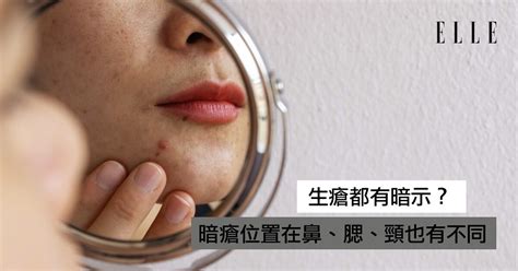 生暗瘡解決|【暗瘡位置】不同代表什麼？中醫教如何處理及預防